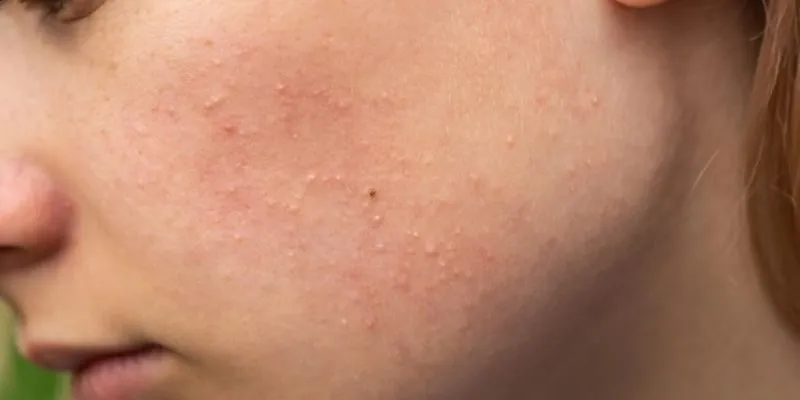 Nguyên nhân gây mụn ẩn