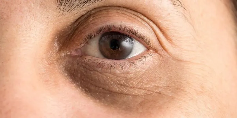 Nguyên Nhân Gây Ra Quầng Thâm Mắt