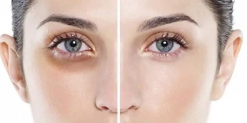 Tạm Biệt Quầng Thâm Mắt: Cách Khắc Phục Tại Nhà Hiệu Quả Nhất